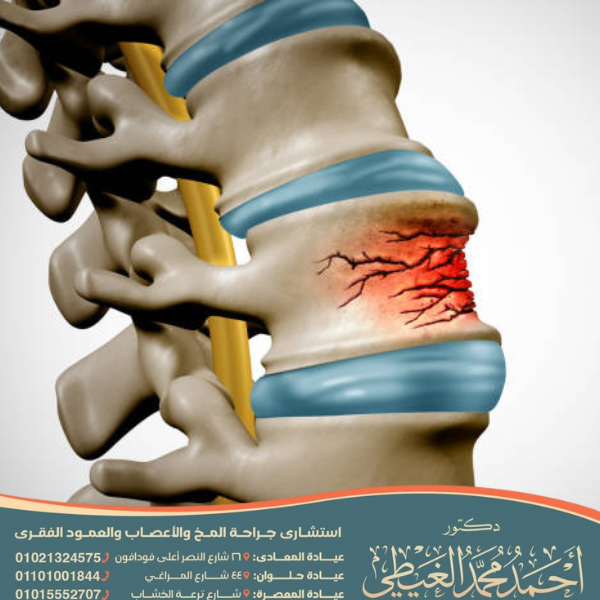 علاج كسر فقرة الظهر