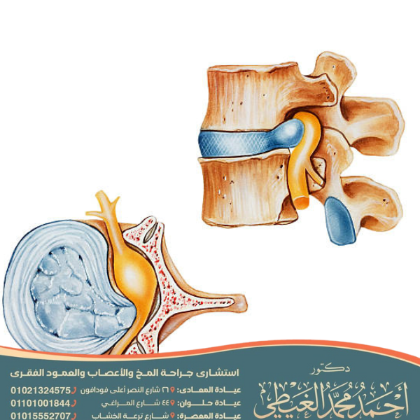 عملية الغضروف في الظهر