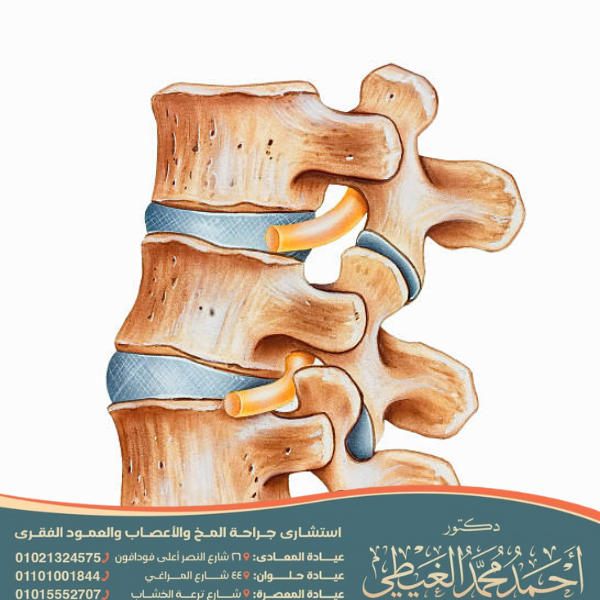 عملية الغضروف في الظهر