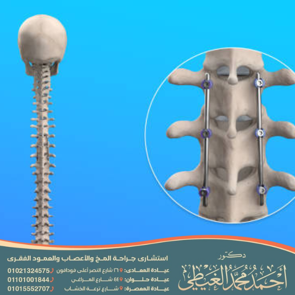 متى يسمح بالجماع بعد عملية تثبيت الفقرات