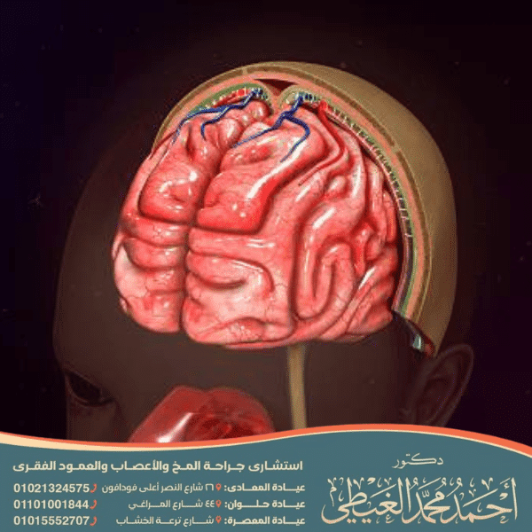 عملية الشنط الدماغي