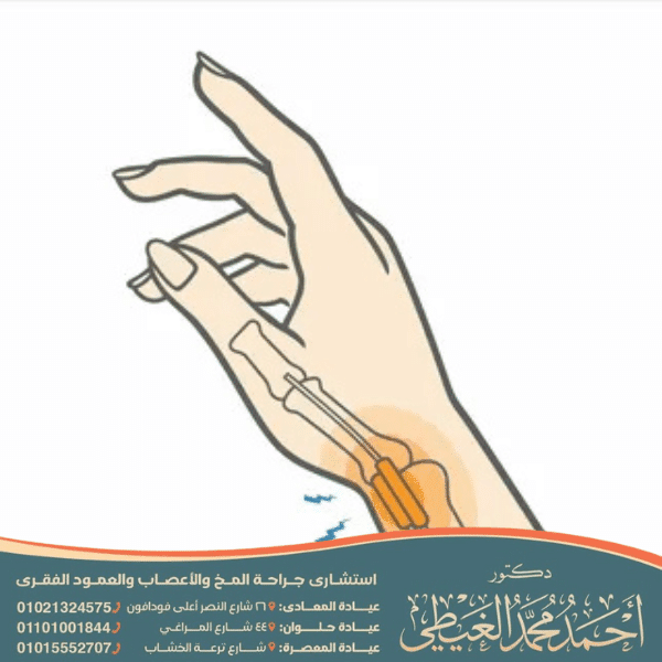 عملية تسليك وتر الإبهام