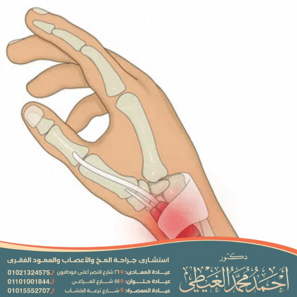 عملية تسليك وتر الإبهام