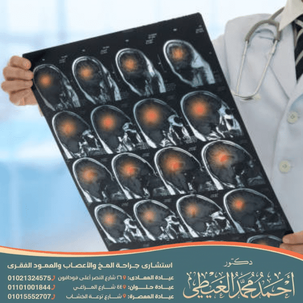 عملية نزيف المخ