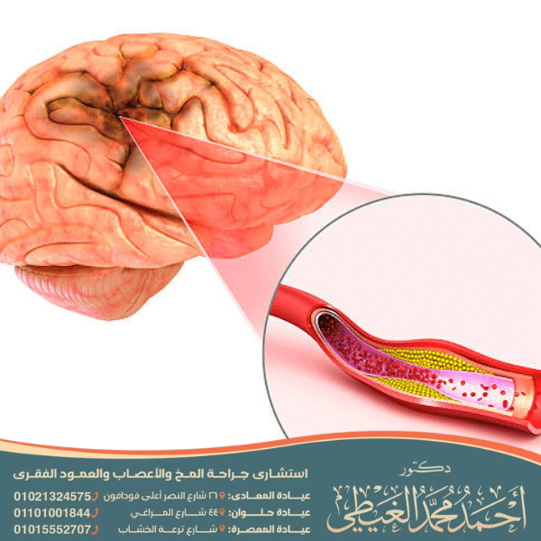 عملية نزيف المخ