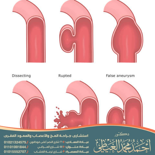 هل تسرب السائل النخاعي خطير