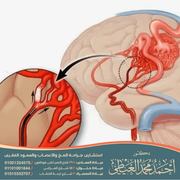 أسباب قسطرة المخ
