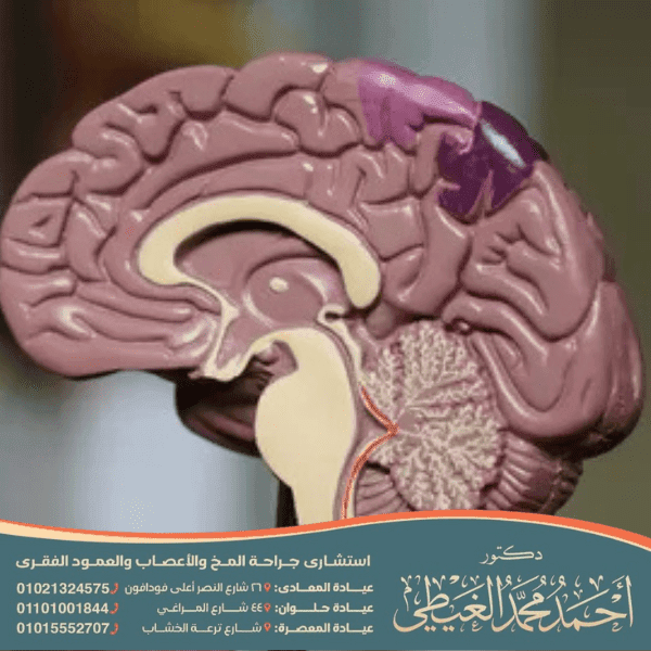 أسباب قسطرة المخ