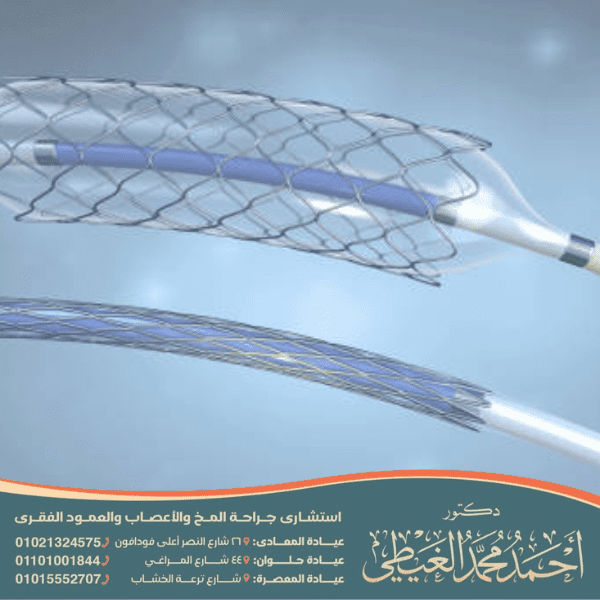 أسباب قسطرة المخ