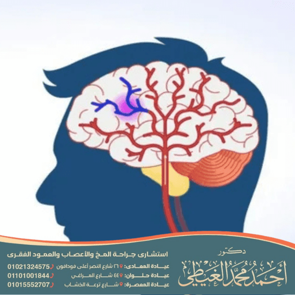 الصرع الرولاندي الخبيث