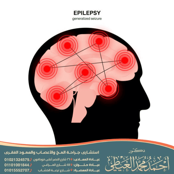 تجربتي في علاج الصرع