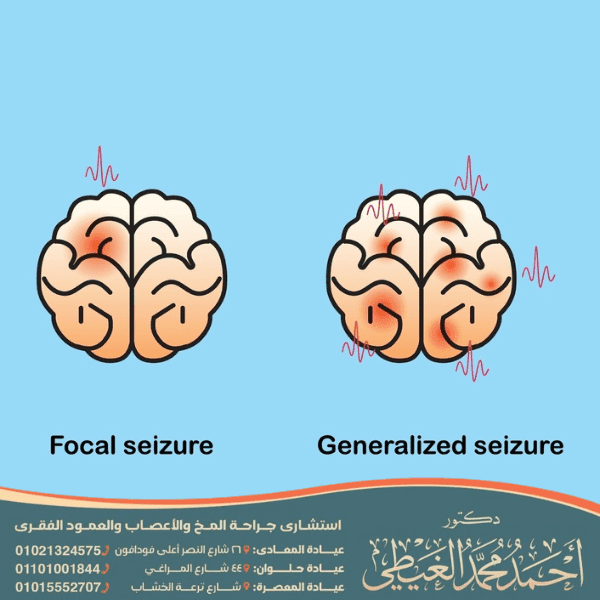 أخطر أنواع الصرع
