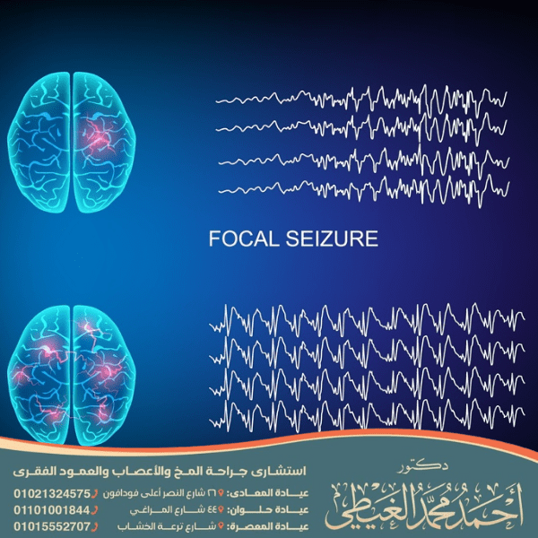 أخطر أنواع الصرع