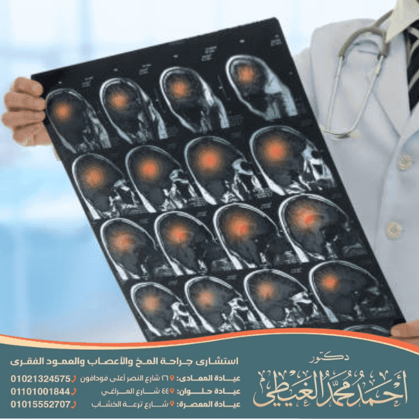 تكلفة عملية نزيف المخ