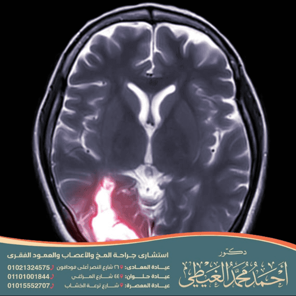 تكلفة عملية نزيف المخ