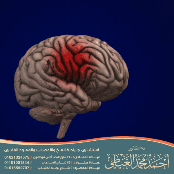 تكلفة عملية نزيف المخ