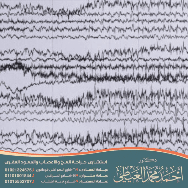 علاج الصرع الحميد