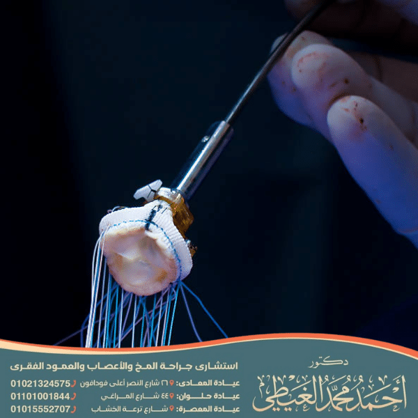 عملية زرع صمام في الدماغ