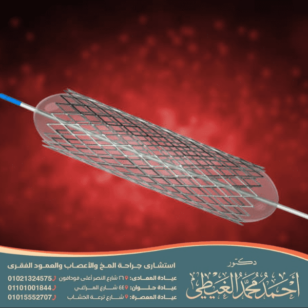 كم تستغرق عملية قسطرة الدماغ