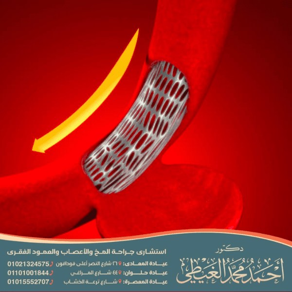 كم تستغرق عملية قسطرة الدماغ