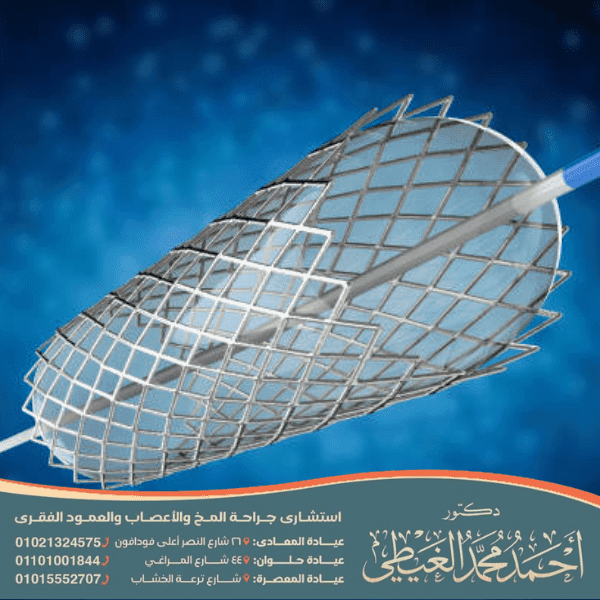 كم تستغرق عملية قسطرة الدماغ