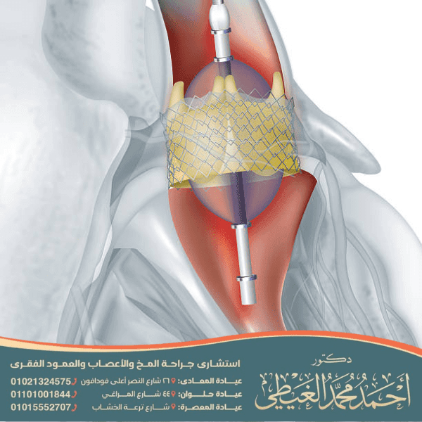كيف تتم قسطرة المخ