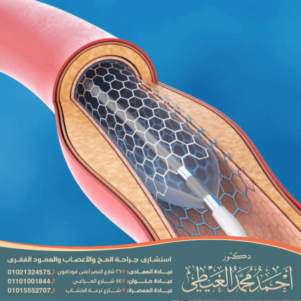 كيف تتم قسطرة المخ