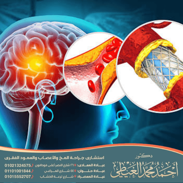 كيف تتم قسطرة المخ