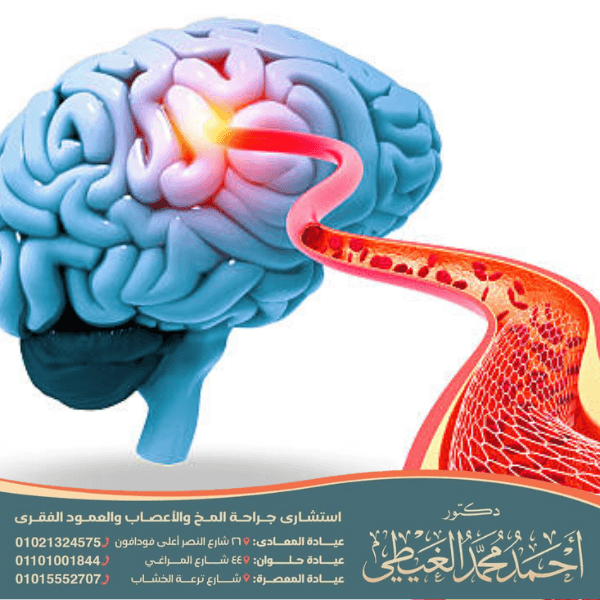 ما بعد عملية قسطرة المخ