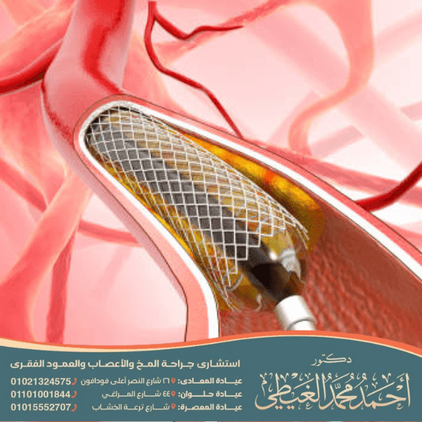 ما بعد عملية قسطرة المخ