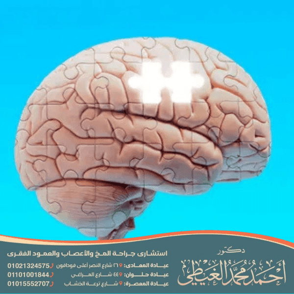 ما بعد عملية قسطرة المخ