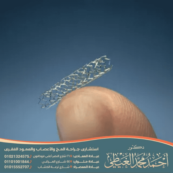 هل تركيب دعامة دوائية يعود المريض لحياته الطبيعية