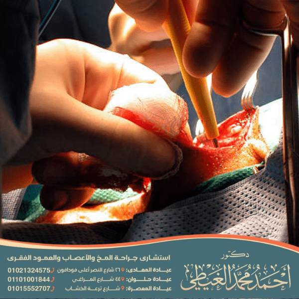 استئصال بطانة الشريان السباتي