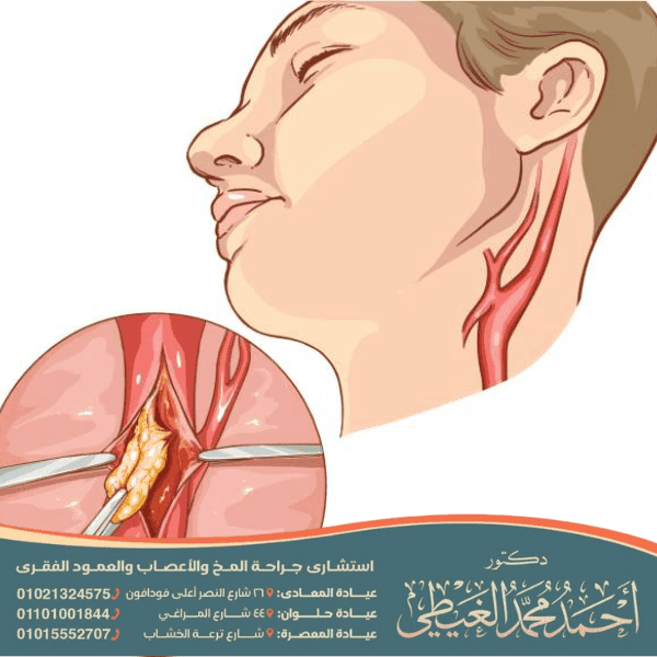 استئصال بطانة الشريان السباتي