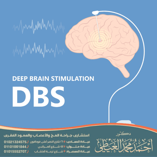 تكلفة عملية الشلل الرعاش في مصر