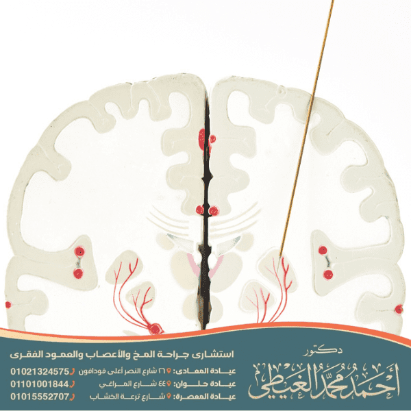 تكلفة عملية الشلل الرعاش في مصر