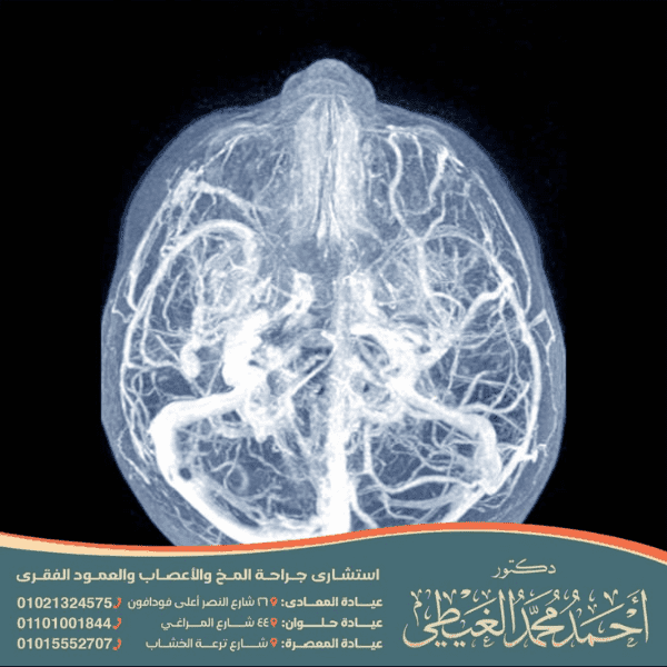 خثار الجيب الوريدي المخي