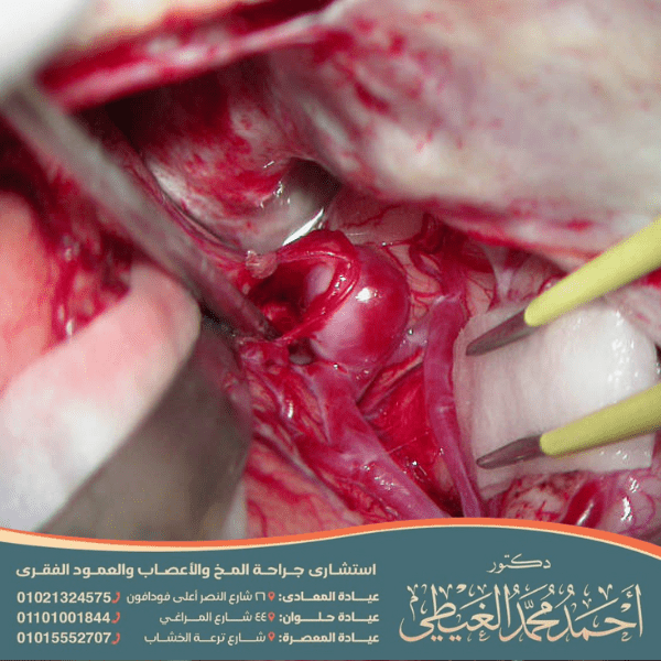 خثار الجيب الوريدي المخي