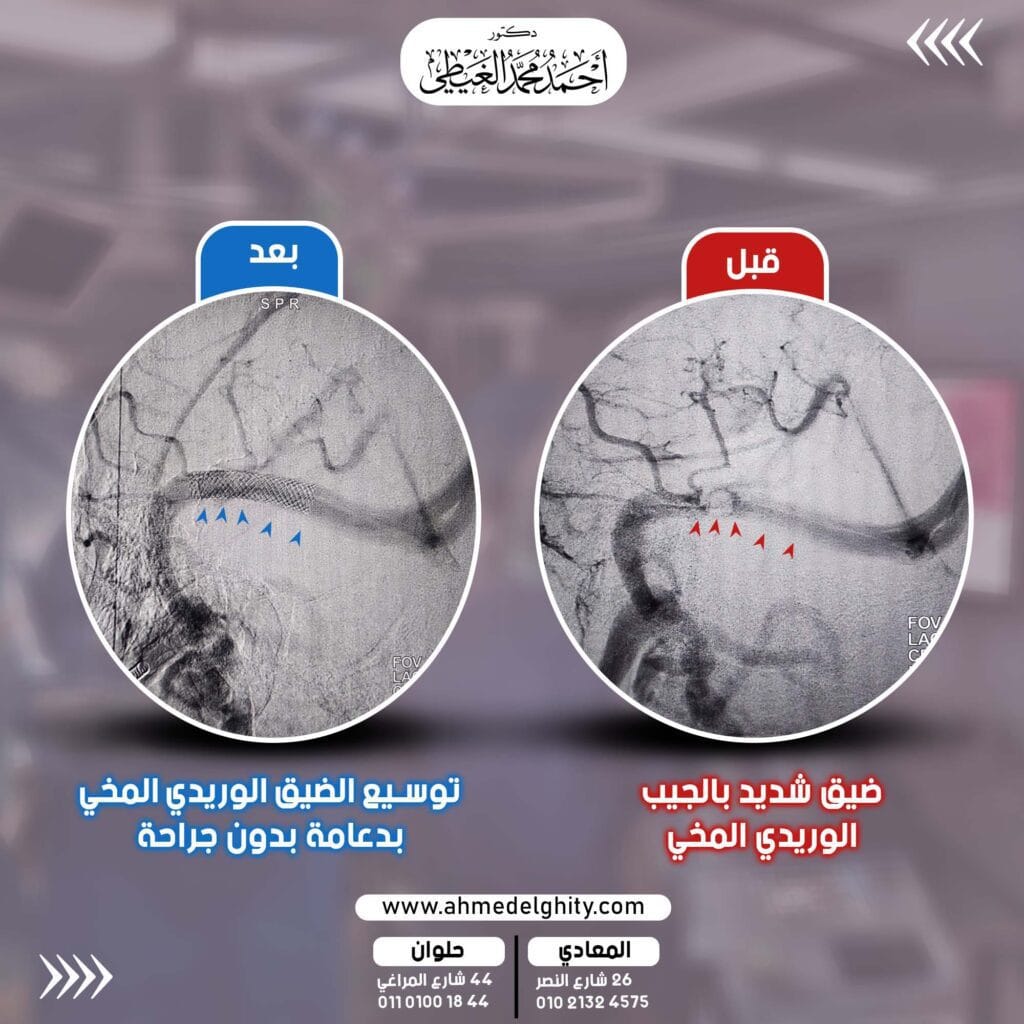 مقدمة: رسالة من الدكتور أحمد الغيطي حول الصداع والطنين "هل تعاني من صداع مستمر، يزداد سوءًا في الصباح؟ هل تسمع صوت طنين يشبه النبض في أذنيك؟ هل لاحظت زغللة في الرؤية؟" بهذه الأسئلة يبدأ الدكتور أحمد الغيطي حديثه مع العديد من مرضاه. فهذه الأعراض ليست مجرد إرهاق عابر، بل قد تكون مؤشرات مهمة على وجود حالة طبية دقيقة، والتي يكون ارتشاح العصب البصري علامتها الأكثر إلحاحًا. في هذا المقال، يأخذنا الدكتور أحمد الغيطي، استشاري جراحة المخ والأعصاب والقسطرة المخية التداخلية، في رحلة لفهم هذه الحالة، وكيفية تشخيصها وعلاجها بأحدث التقنيات المتطورة التي يعتمد عليها في مركزه، والتي تعيد الأمور إلى نصابها بأمان وفعالية، وبدون الحاجة إلى جراحة. ما هو ارتشاح العصب البصري من منظور الدكتور أحمد الغيطي؟ يوضح الدكتور الغيطي أن العصب البصري هو بمثابة "الكابل" فائق الدقة الذي ينقل كل ما تراه العين إلى الدماغ. ولكي نفهم ارتشاحه، يجب أن نتخيل أن الدماغ يطفو برفق داخل الجمجمة في سائل نقي يسمى "السائل النخاعي الشوكي"، وظيفته حماية الدماغ وتنظيم الضغط حوله. عندما يرتفع ضغط هذا السائل عن حده الطبيعي، فإنه يضغط على أنسجة المخ، وأحد أول الأماكن تأثرًا هو العصب البصري عند نقطة اتصاله بالعين، مما يؤدي إلى تورّمه وانتفاخه. هذا هو ما يُعرف طبيًا بارتشاح أو وذمة العصب البصري (Papilledema). يؤكد الدكتور الغيطي دائمًا لمرضاه: "أن هذا ليس مرضًا في العين بحد ذاته، بل هو علامة تحذيرية من وجود ضغط مرتفع داخل الدماغ. لذلك، التعامل مع هذا الارتشاح ليس خيارًا، بل ضرورة لحماية بصرك، لأن استمرار الضغط قد يسبب تلفًا دائمًا في العصب البصري يصل إلى فقدان البصر الكامل." ضيق الجيب الوريدي: كشف السبب الخفي الذي يركز عليه د. الغيطي يشرح الدكتور أحمد الغيطي أن الدماغ لديه نظام دقيق لتصريف الدم. يتم هذا الصرف عبر أوردة كبيرة ومنظمة تسمى "الجيوب الوريدية". في بعض الحالات، يحدث تضيّق في أحد أهم هذه الأوردة، وهو "الجيب الوريدي المستعرض" (Transverse Sinus). يستخدم د. الغيطي تشبيهًا بسيطًا: "تخيل أن نظام الصرف في الدماغ هو شبكة طرق سريعة. هذا الضيق هو بمثابة 'اختناق مروري' حاد في أحد هذه الطرق الرئيسية، مما يمنع تدفق الدم بسلاسة. هذا الاحتباس لا يسبب ازدحامًا دمويًا فقط، بل يُعيق أيضًا امتصاص السائل النخاعي بشكل فعال، مما يؤدي إلى ارتفاع الضغط داخل الجمجمة، وهو ما يسبب ارتشاح العصب البصري وبقية الأعراض المزعجة." أعراض تستدعي زيارة عيادة الدكتور أحمد الغيطي فورًا ينبه الدكتور الغيطي إلى مجموعة من الإشارات التحذيرية التي تستدعي التقييم الفوري: الصداع المستمر: غالبًا ما يكون صداعًا ضاغطًا أو نابضًا، يزداد في الصباح الباكر، أو عند الاستلقاء أو الانحناء للأمام. طنين الأذن النبضي (Pulsatile Tinnitus): عرض مميز جدًا، حيث يسمع المريض صوت "وشوشة" إيقاعية تتزامن مع نبضات القلب. تشوش الرؤية: يبدأ بزغللة مؤقتة، وقد يتطور إلى رؤية ومضات ضوئية، أو ازدواج في الرؤية، أو فقدان أجزاء من مجال الرؤية. أعراض أخرى: قد تشمل آلامًا في الرقبة والكتفين، وشعورًا بالغثيان، أو الدوخة. بروتوكول التشخيص الدقيق الذي يتبعه الدكتور أحمد الغيطي للوصول إلى تشخيص قاطع ورسم صورة كاملة لما يحدث داخل الرأس، يعتمد الدكتور أحمد الغيطي على بروتوكول تشخيصي متكامل: فحص قاع العين: هو الخطوة الأولى والأساسية في العيادة، حيث يقوم الدكتور الغيطي بفحص العصب البصري مباشرةً لتقييم درجة التورم. أشعة الرنين المغناطيسي مع تصوير الأوردة (MRV): يطلبها الدكتور الغيطي لرسم خريطة دقيقة للجيوب الوريدية، وتحديد وجود أي تضيّق ودرجة تأثيره على تدفق الدم. البزل القطني (Lumbar Puncture): قد يلجأ إليه الدكتور الغيطي لقياس ضغط السائل المخي بشكل مباشر وتأكيد وجود ارتفاع فيه، وهو إجراء يوفر أيضًا راحة مؤقتة من الصداع. كيف يضع الدكتور أحمد الغيطي خطتك العلاجية الشخصية؟ يؤمن الدكتور أحمد الغيطي بأن كل مريض حالة فريدة. فبعد اكتمال التشخيص، يقوم بوضع خطة علاجية مخصصة بناءً على شدة الأعراض، ونتائج الفحوصات، والحالة الصحية العامة للمريض. قد تبدأ الخطة بالعلاج الدوائي، ولكن عندما تؤكد الفحوصات أن ضيق الجيب الوريدي هو السبب الرئيسي، فإن خبرة الدكتور الغيطي الطويلة ترجح اللجوء إلى الحل الأكثر فعالية وهو القسطرة التداخلية وتركيب الدعامة، لأنه يعالج أصل المشكلة. تركيب الدعامة الوريدية: التقنية المتقدمة التي يتقنها د. أحمد الغيطي هذا الإجراء الدقيق هو قمة التكنولوجيا الطبية في هذا المجال، ويهدف إلى إصلاح "الاختناق المروري" في وريد الدماغ بدون أي جراحة. خطوات الإجراء كما يقوم به الدكتور الغيطي: المدخل الآمن: يقوم الدكتور أحمد الغيطي بعمل فتحة صغيرة جدًا (لا تتجاوز 2-3 ملم) في وريد كبير بالفخذ، تحت تأثير التخدير الموضعي. التوجيه الدقيق: عبر هذه الفتحة، يُدخل قسطرة رفيعة ومرنة، ويوجهها بخبرته الفائقة تحت رؤية الأشعة السينية حتى تصل بدقة متناهية إلى الجيب الوريدي المتضيق في الدماغ. الحل الفوري: بعد تأكيد مكان الضيق بالصبغة، يقوم بتركيب دعامة معدنية دقيقة في مكان التضيق، ثم يفتحها لتعمل كسقالة دائمة تبقي الوريد مفتوحًا وتضمن عودة تدفق الدم إلى طبيعته بسلاسة. رحلة التعافي: برنامج المتابعة مع الدكتور أحمد الغيطي "نجاح العملية لا يكتمل إلا بالتزامك بخطة المتابعة،" هذا ما يؤكد عليه الدكتور الغيطي لمرضاه. ويشمل برنامج المتابعة الخاص به: نظام لأدوية السيولة: يصفه لفترة محددة لمنع تكون أي جلطات. فحوصات دورية للنظر: لمراقبة تحسن ارتشاح العصب البصري وعودة الرؤية إلى طبيعتها. تصوير دوري بالأشعة: للاطمئنان على وضع الدعامة وفعاليتها على المدى الطويل. خلاصة: رسالة أمل من الدكتور أحمد الغيطي ارتشاح العصب البصري ليس نهاية المطاف، بل هو نداء واضح من جسمك للبحث عن السبب. وعندما يكون هذا السبب هو ضيق الجيب الوريدي المخي، فإن العلم الحديث وخبرتي كجراح متخصص في هذا المجال، نقدم لك حلاً ثوريًا وآمنًا عبر تركيب دعامة بالقسطرة التداخلية. هذا الإجراء لا يعالج الأعراض فقط، بل يعيد التوازن الطبيعي للدماغ، ليحميك أنت من تطور الأعراض، والأهم من ذلك، ليحافظ على نعمة البصر التي لا تقدر بثمن.
