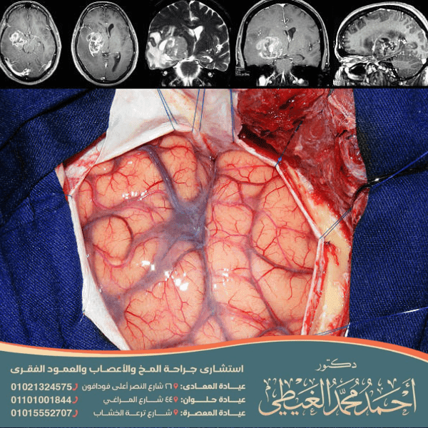 كم يعيش مريض ورم الدماغ الحميد
