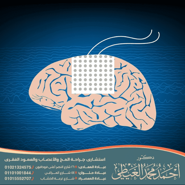 هل عملية الصرع خطيرة