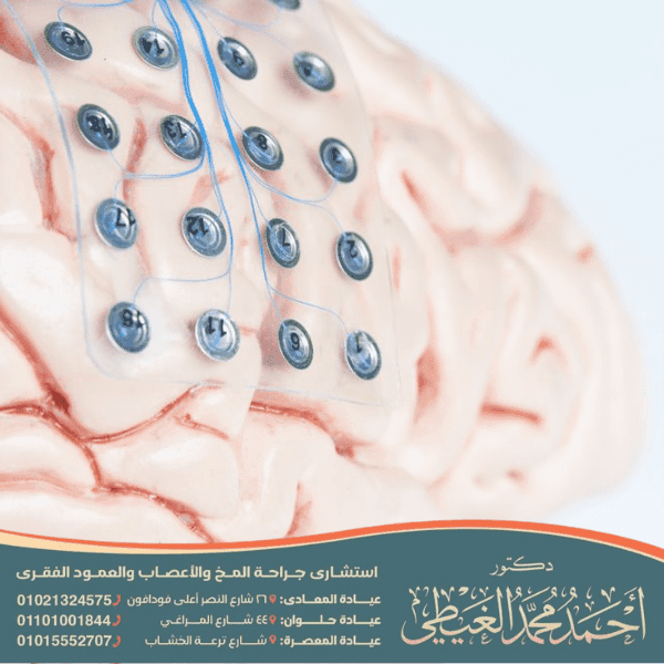 هل عملية الصرع خطيرة