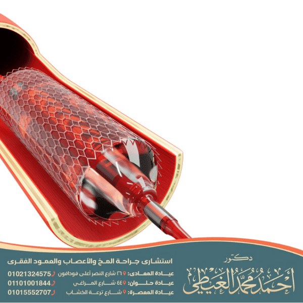 هل عملية قسطرة الدماغ خطيرة