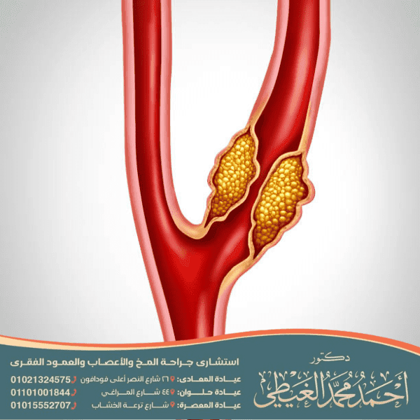 ورم الشريان السباتي