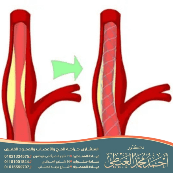 ورم الشريان السباتي
