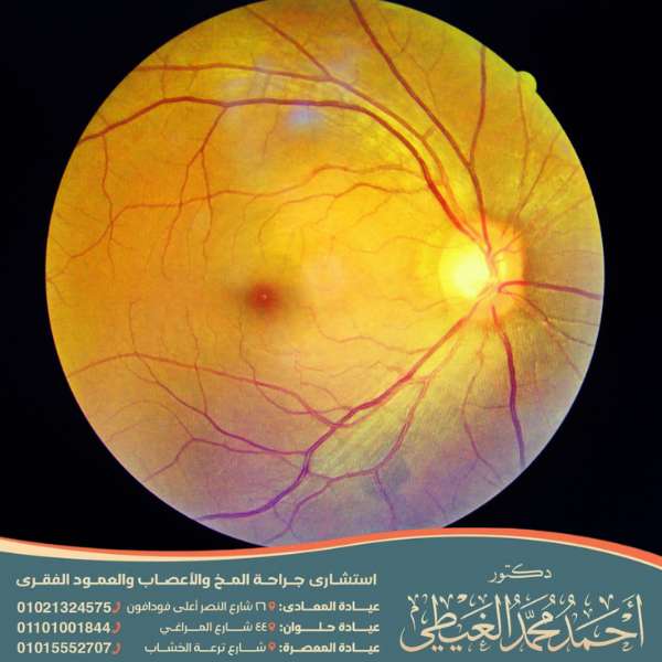 درجات ارتشاح العصب البصري