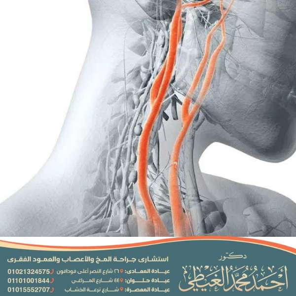 تجربتي مع انسداد الشريان السباتي