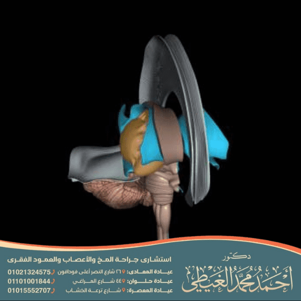 أضرار غياب الجسم الثفني