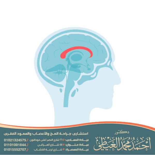 أضرار غياب الجسم الثفني