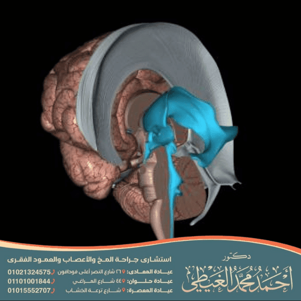 أضرار غياب الجسم الثفني